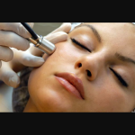 Microdermabrasion